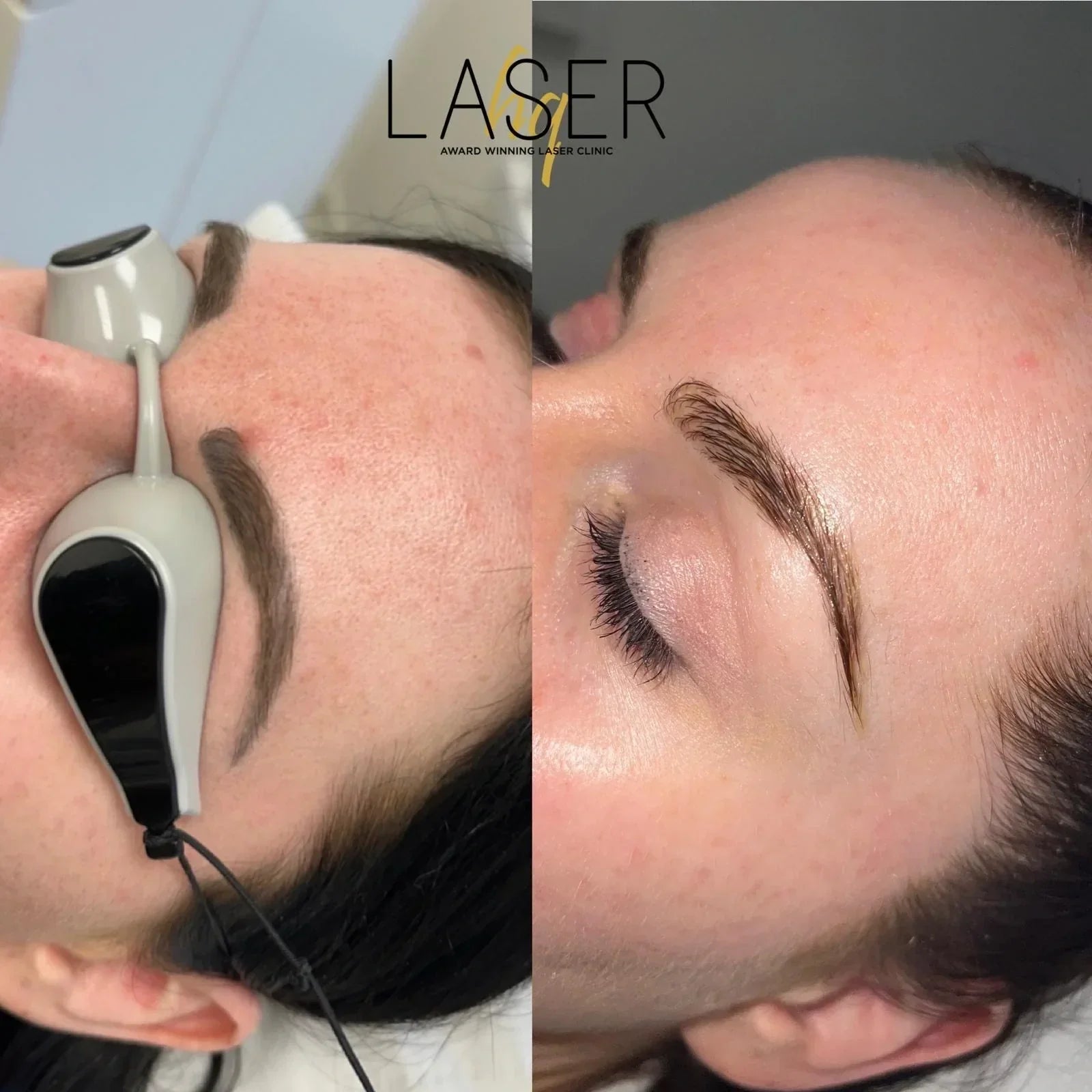 Navigating the Process of Removing Semi-Permanent Eyebrows and Getting Them Re-Microbladed After Six Weeks