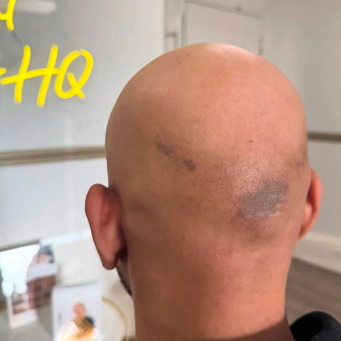 Men's Scalp Laser Hair Removal: The Ultimate Guide