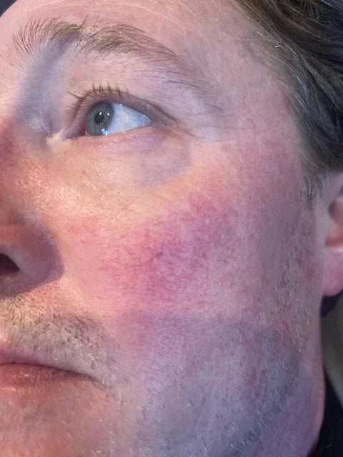 Say Goodbye to Thread Veins with Advanced Laser Removal