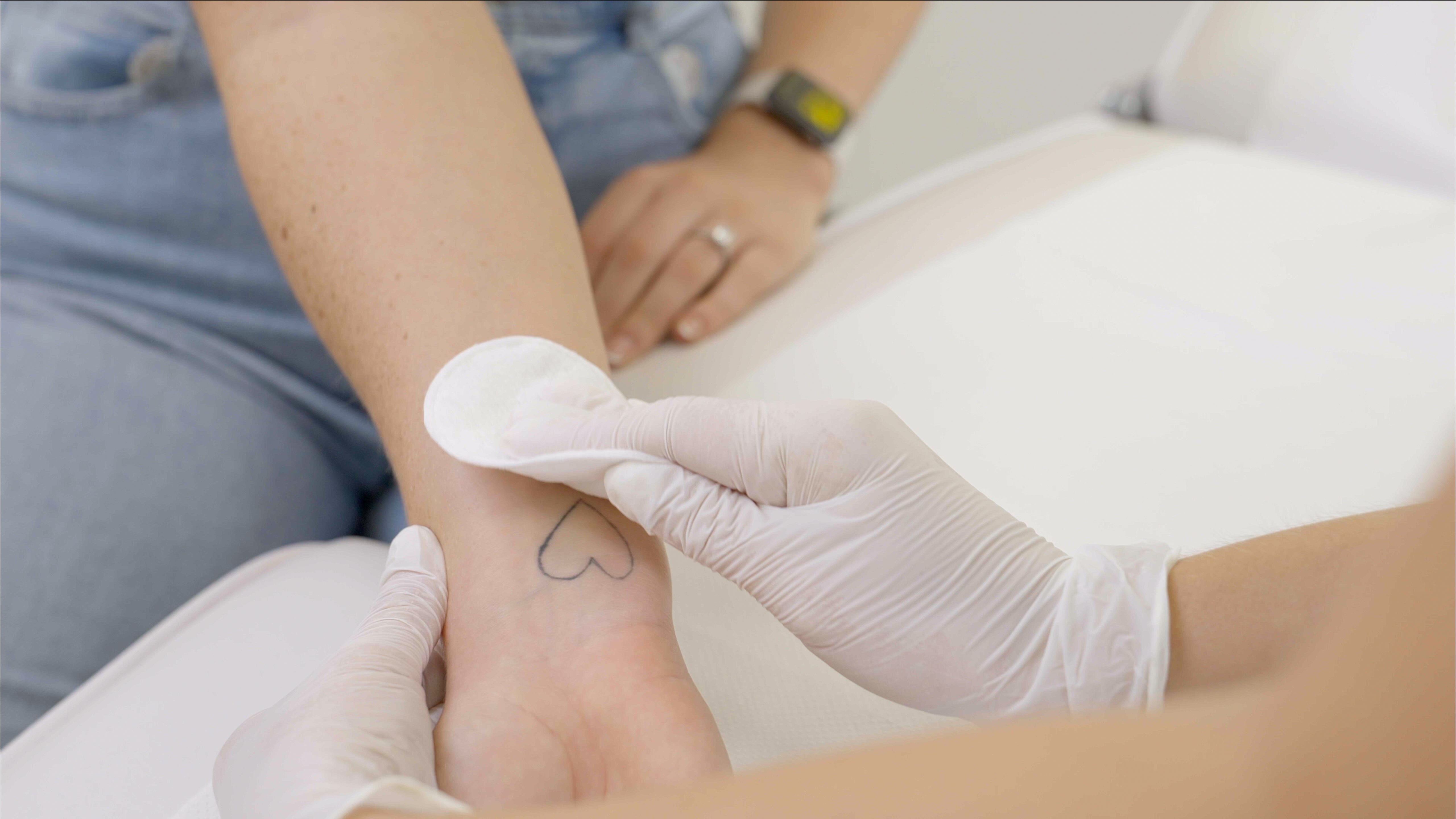 Does laser tattoo removal hurt?