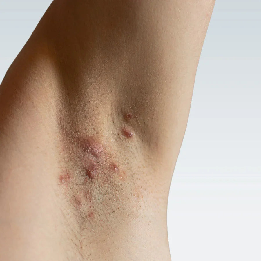 How Laser Hair Removal Helps with Hidradenitis Suppurativa: A Confidence Boost with LaserHQ