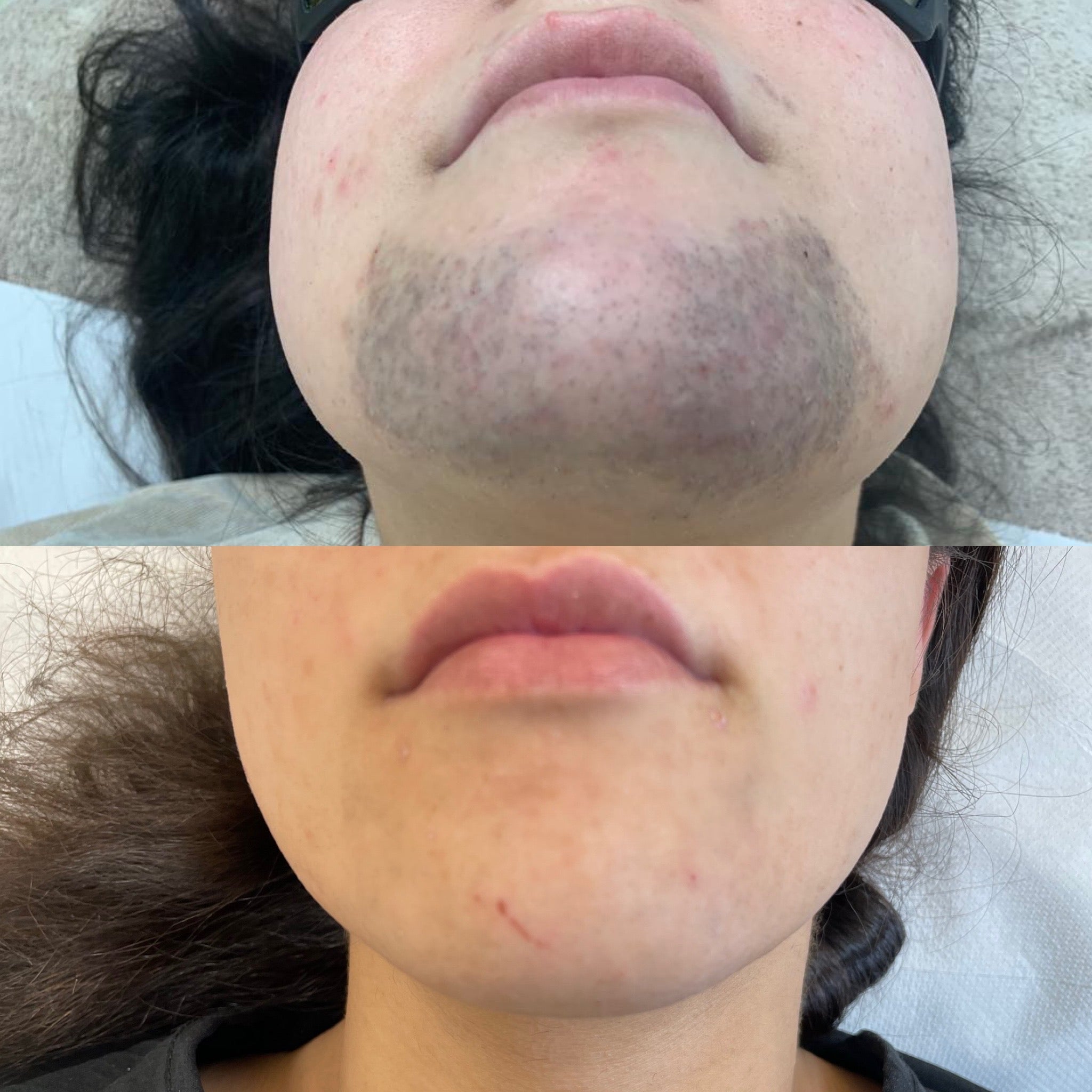 Laser Hair Face Treatments - LaserHQ-MARCA-MEDIA
