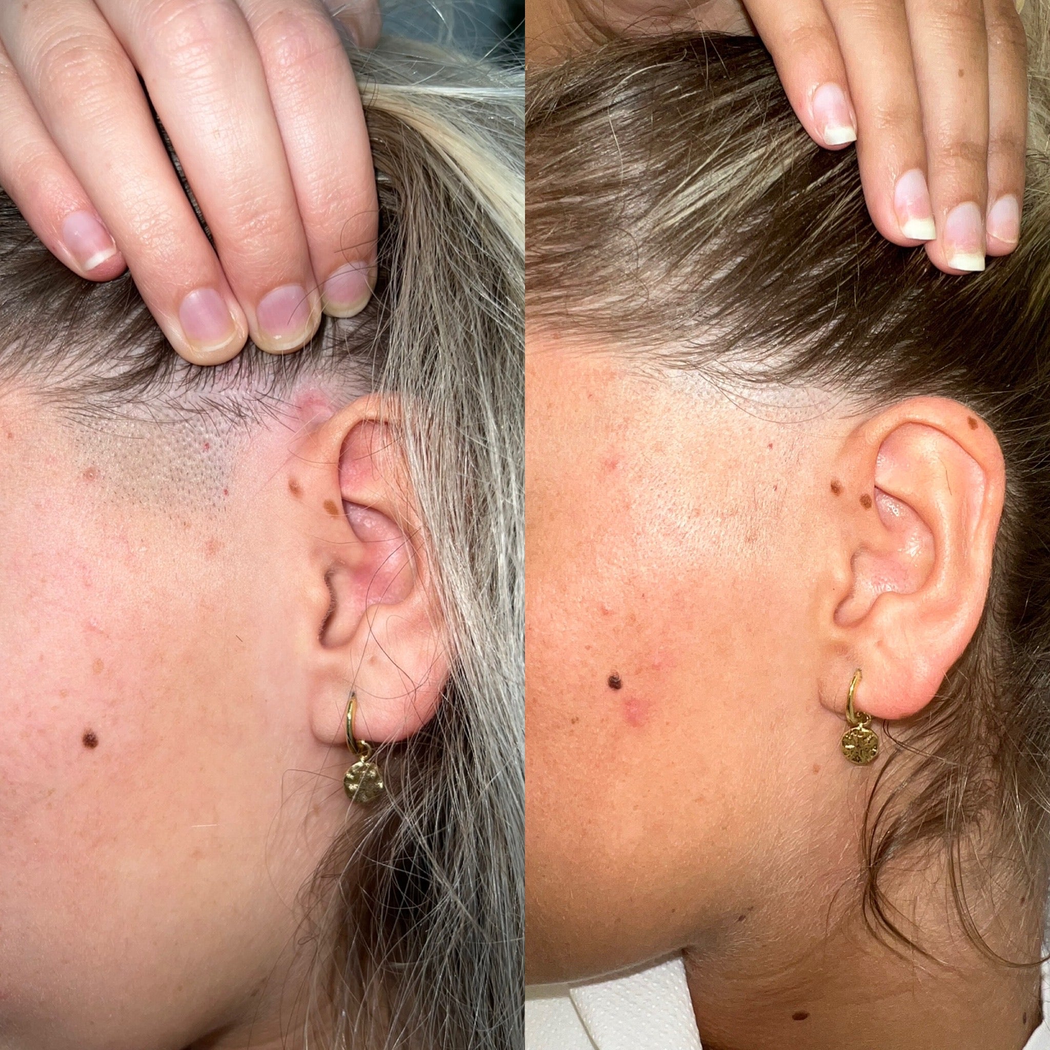 Laser Hair Face Treatments - LaserHQ-MARCA-MEDIA
