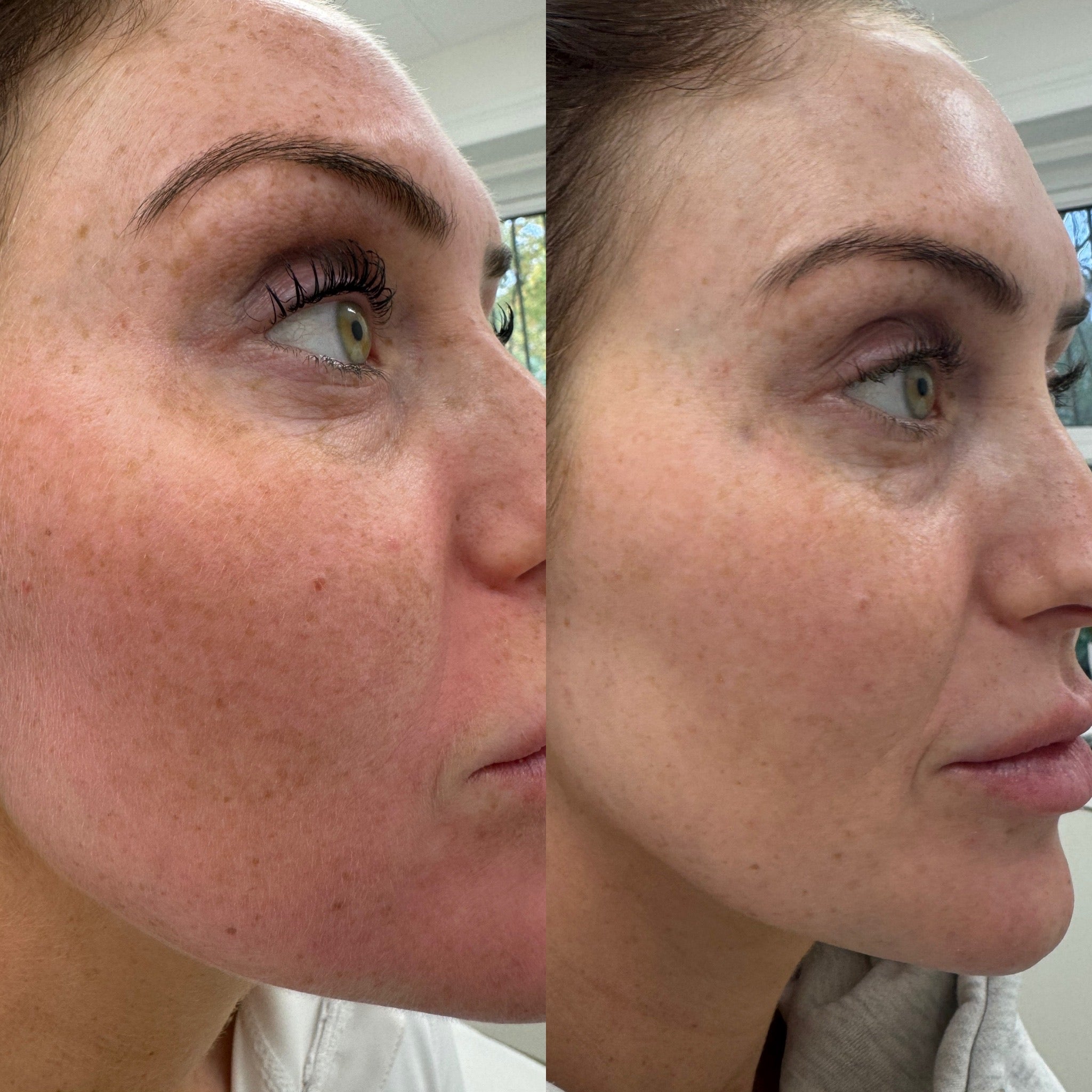 Sunerase Facial Consultation - LaserHQ-MARCA-MEDIA