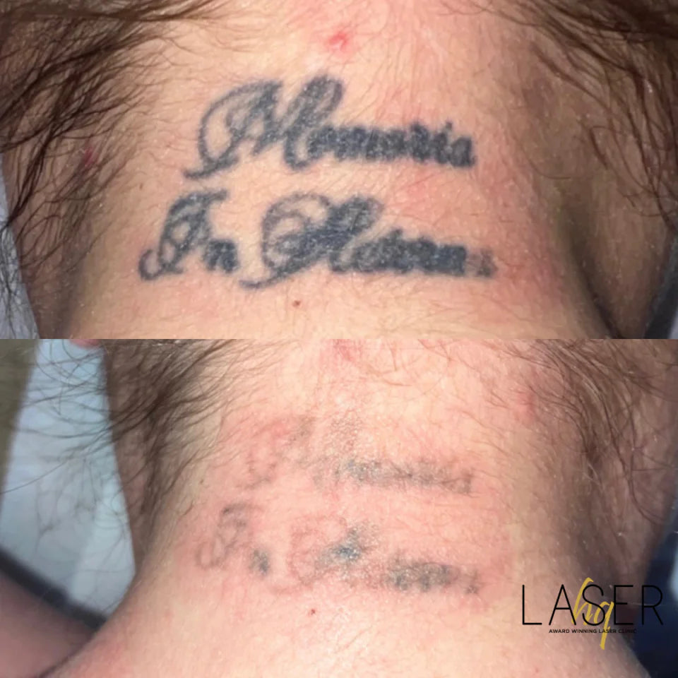 Tattoo Removal - LaserHQ-MARCA-MEDIA