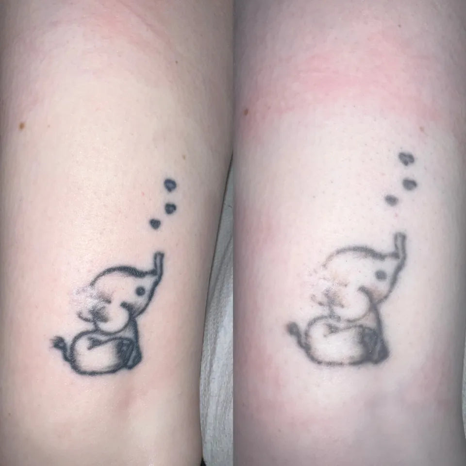 Tattoo Removal - LaserHQ-MARCA-MEDIA