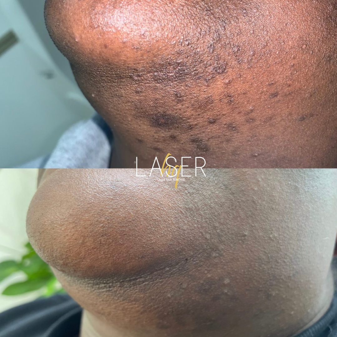 Laser Hair Face Treatments - LaserHQ-MARCA-MEDIA