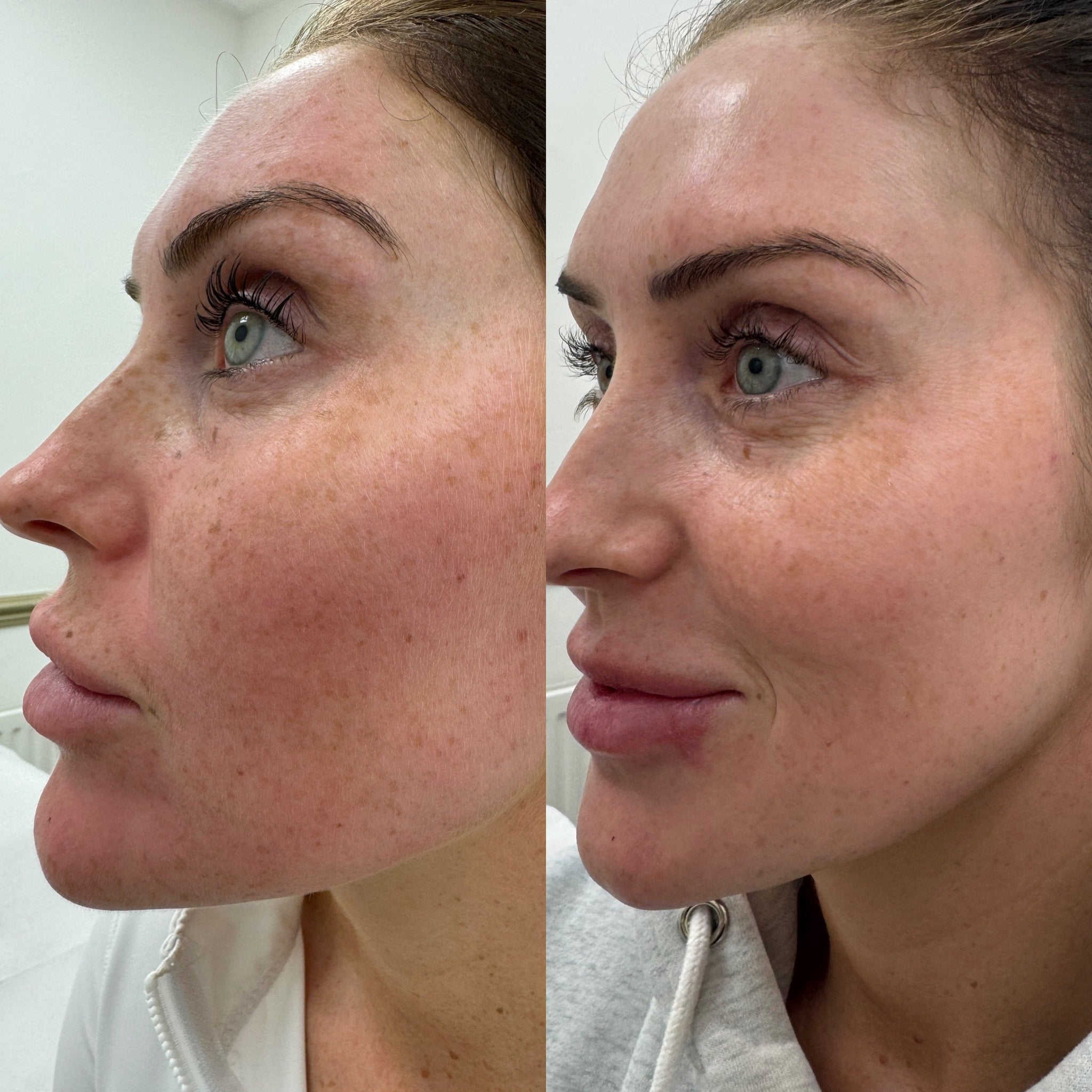 Sunerase Facial Consultation - LaserHQ-MARCA-MEDIA