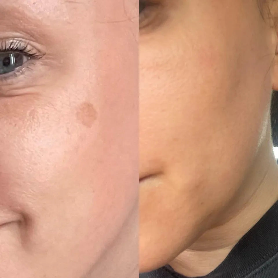 Pigmentation Consultation - LaserHQ-MARCA-MEDIA