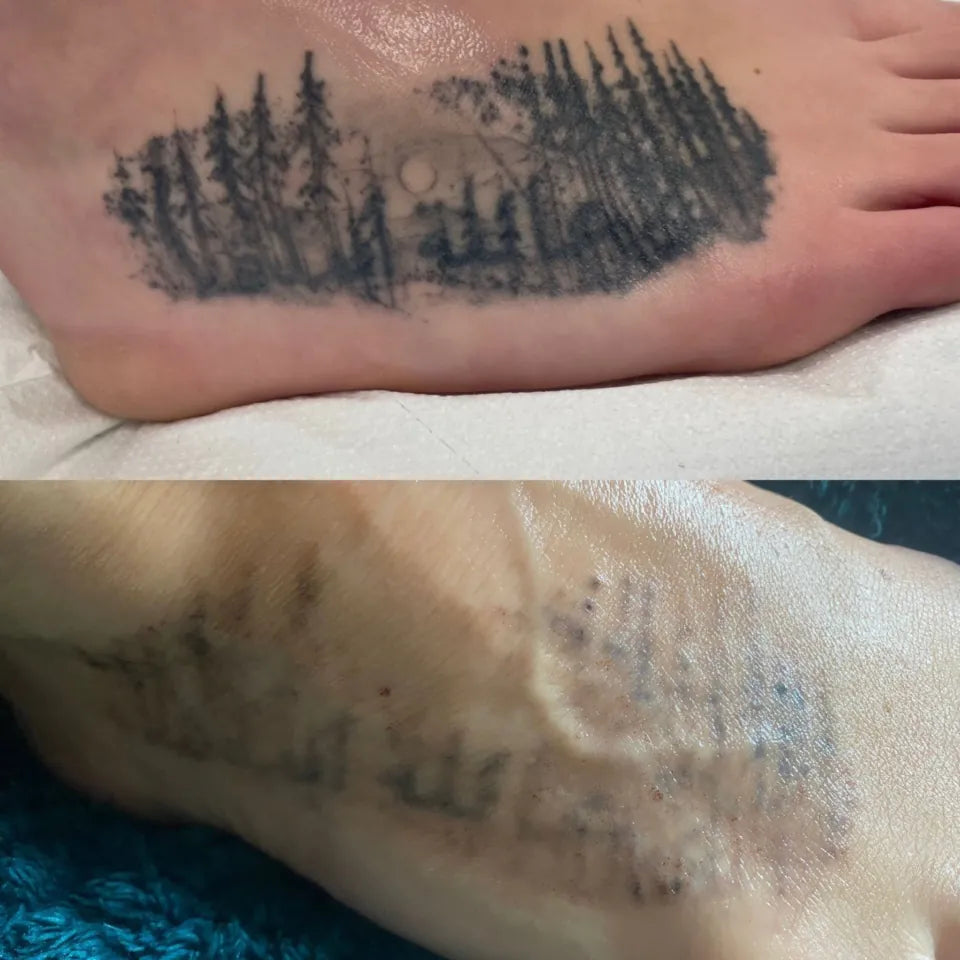 Tattoo Removal - LaserHQ-MARCA-MEDIA