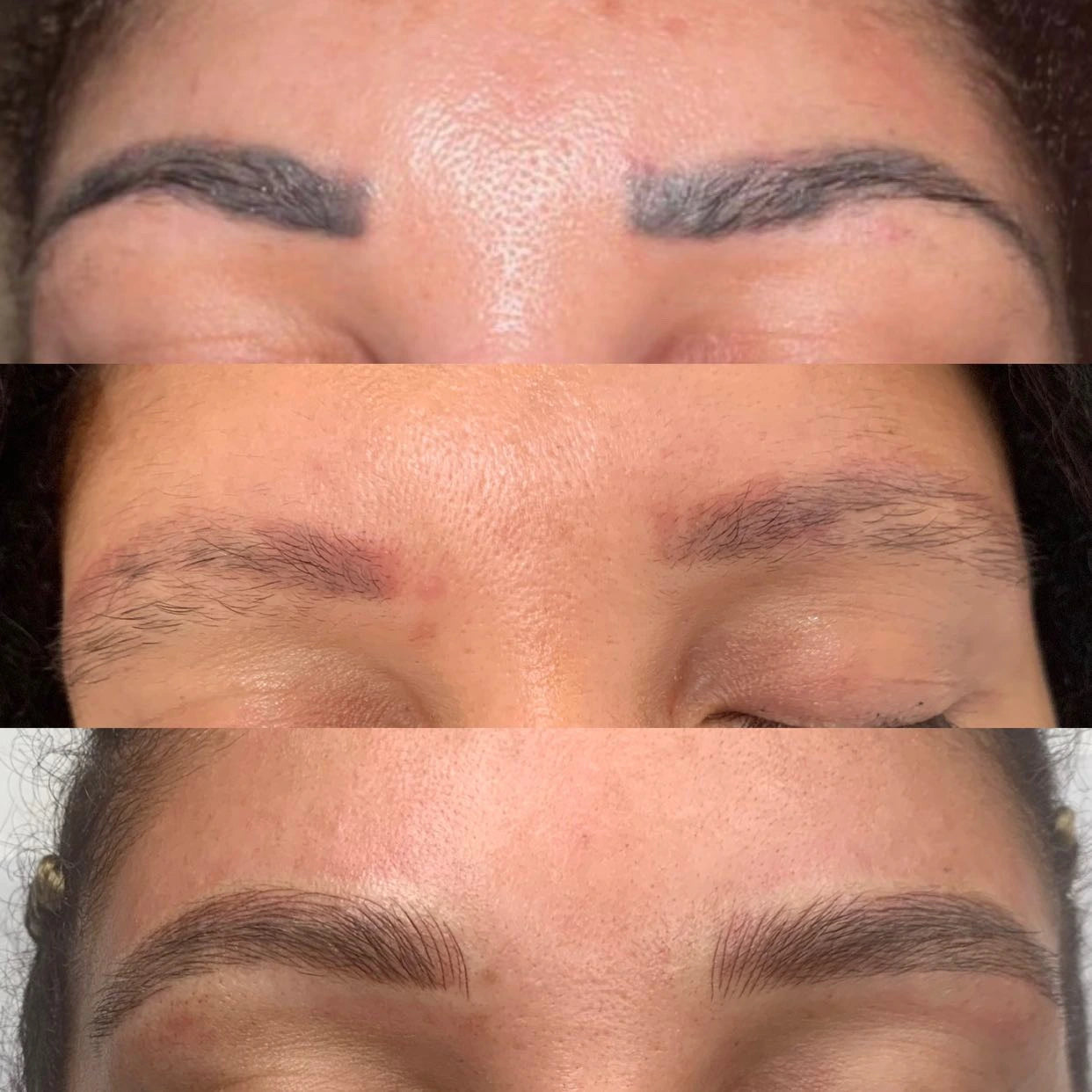 Eyebrow Tattoo Removal - LaserHQ-MARCA-MEDIA