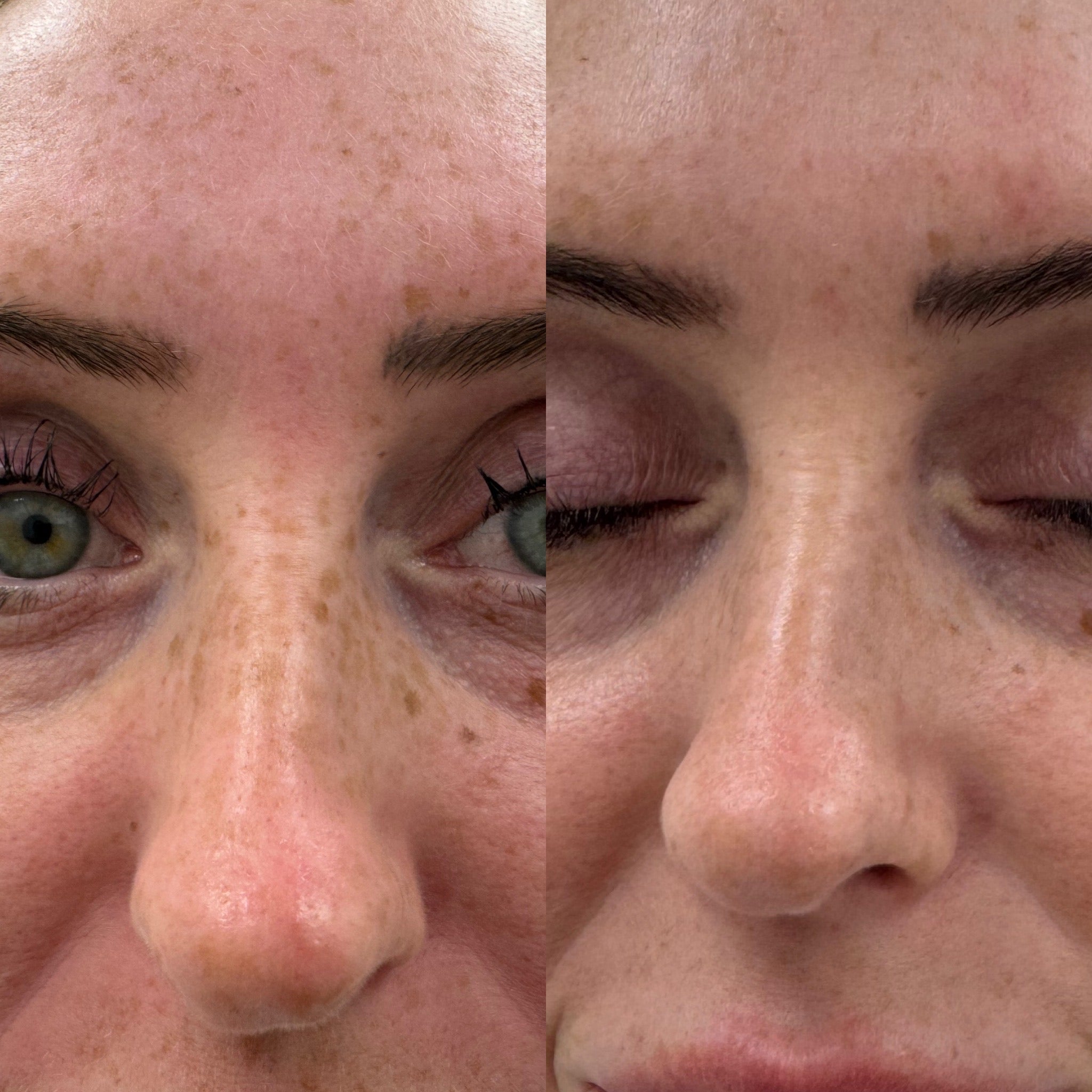Sunerase Facial Consultation - LaserHQ-MARCA-MEDIA