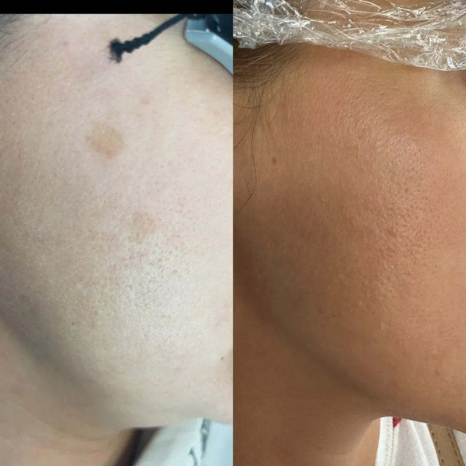 Pigmentation Consultation - LaserHQ-MARCA-MEDIA