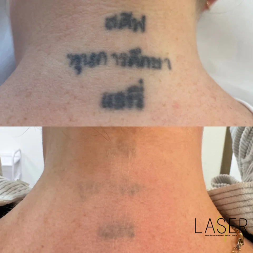 Tattoo Removal - LaserHQ-MARCA-MEDIA