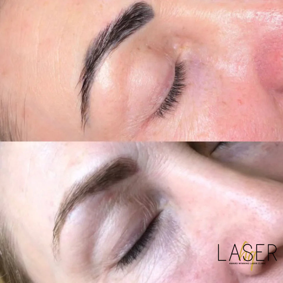 Eyebrow Tattoo Removal - LaserHQ-MARCA-MEDIA
