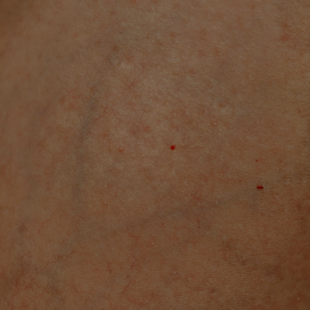 Primelase Cherry Angioma Consultation - LaserHQ-MARCA-MEDIA