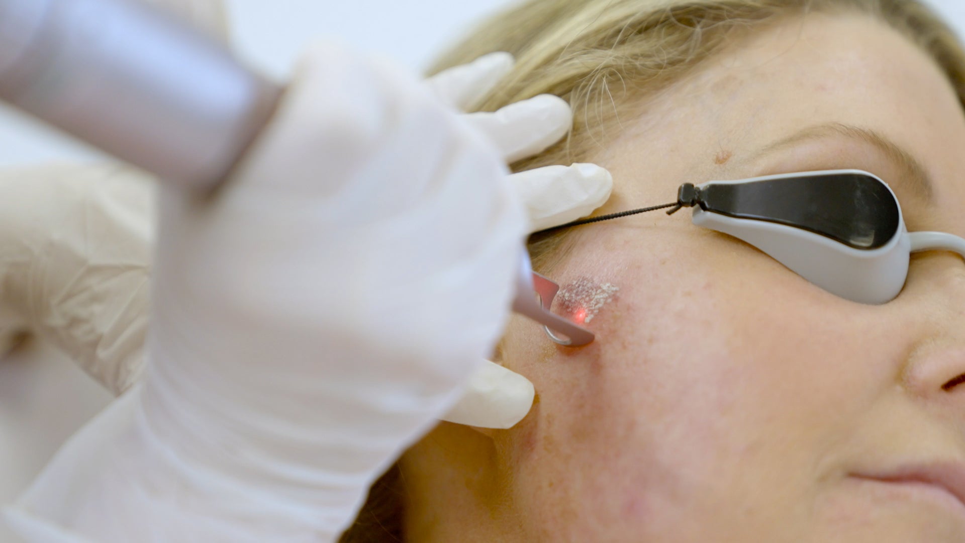 Fractional Laser Consultation - LaserHQ-MARCA-MEDIA