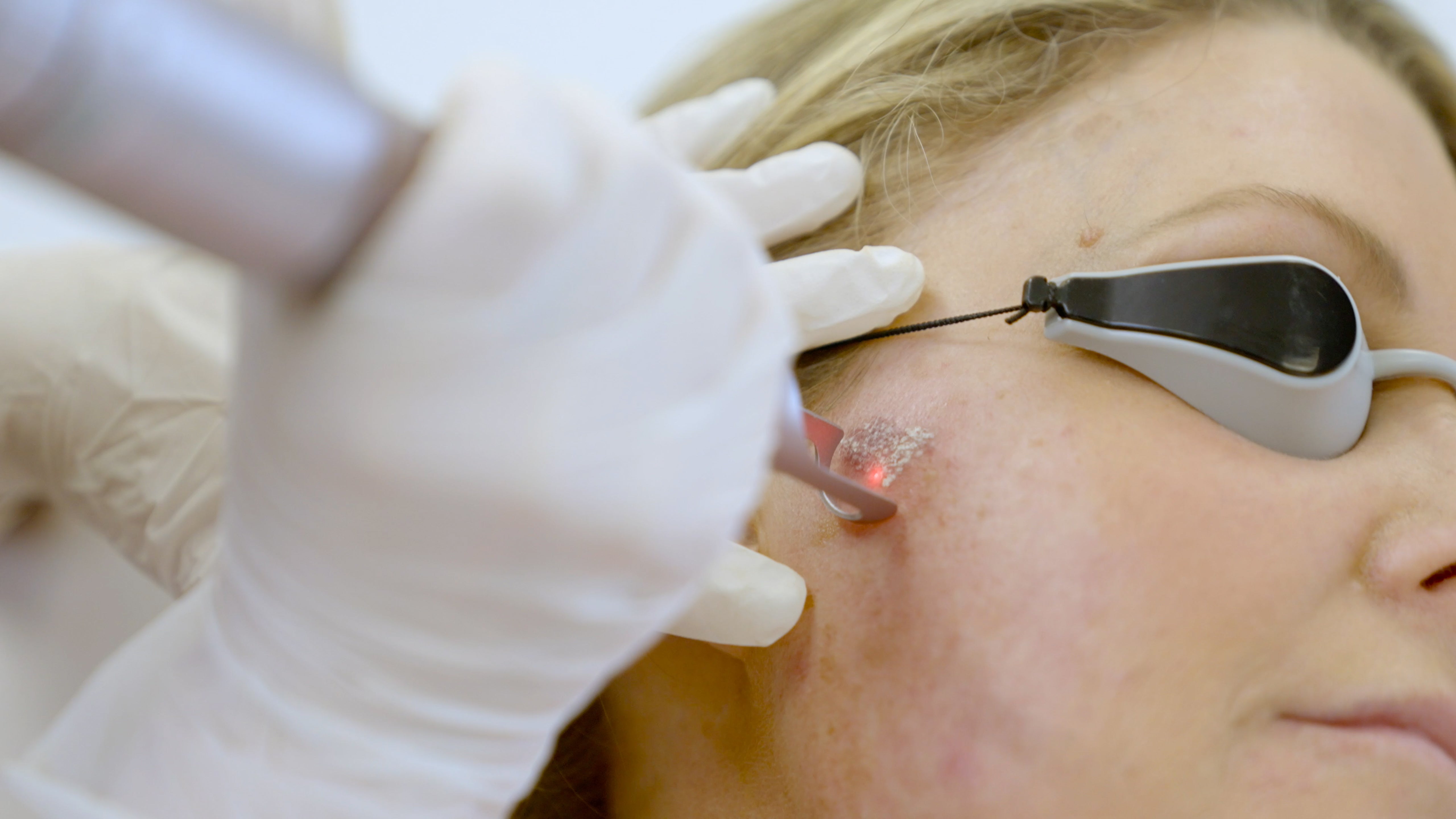 Fractional Laser Consultation - LaserHQ-MARCA-MEDIA
