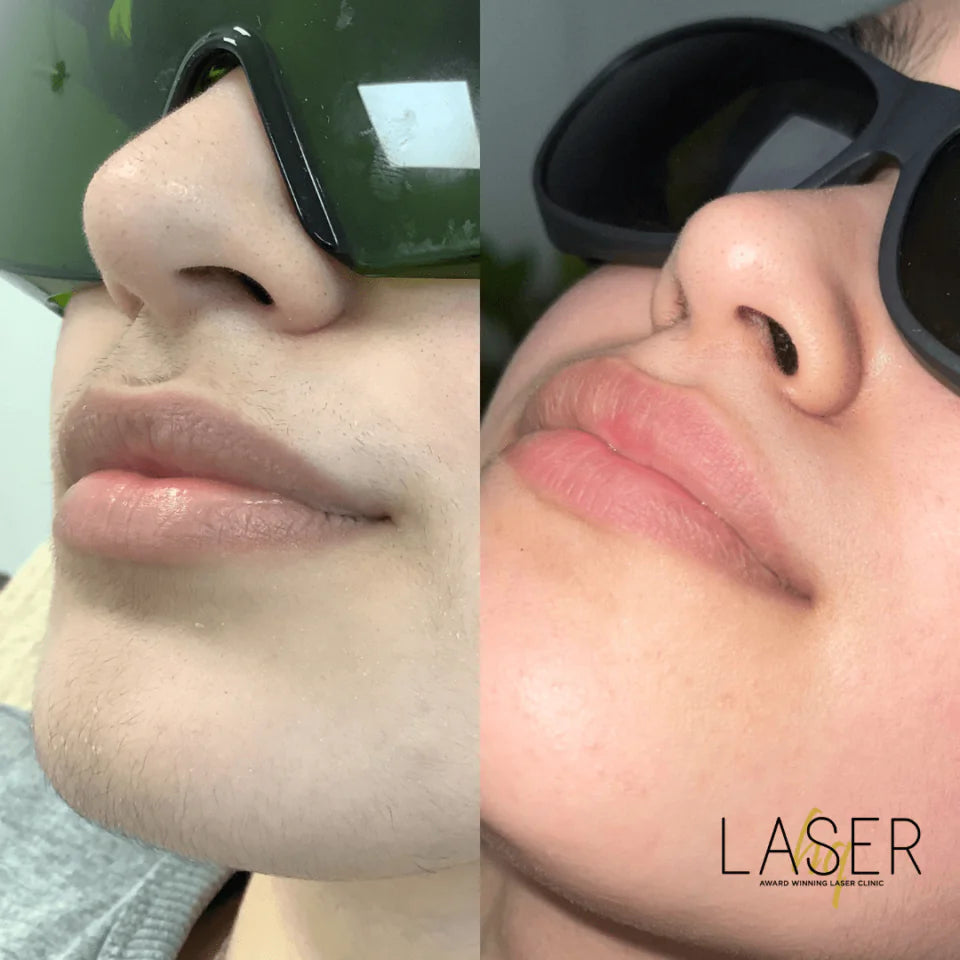 Laser Hair Face Treatments - LaserHQ-MARCA-MEDIA