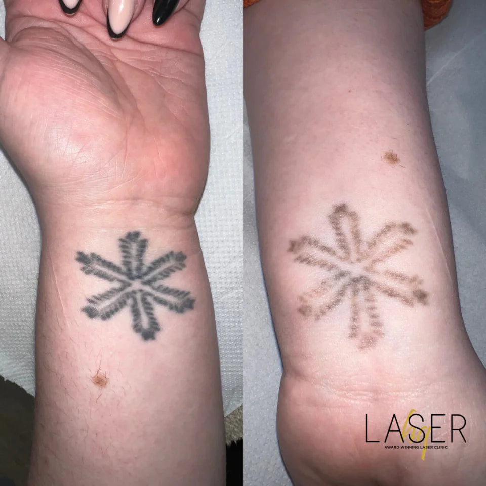 Tattoo Removal - LaserHQ-MARCA-MEDIA
