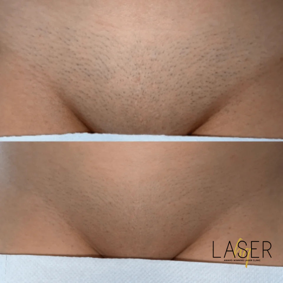 Bikini Prep Packages - LaserHQ-MARCA-MEDIA
