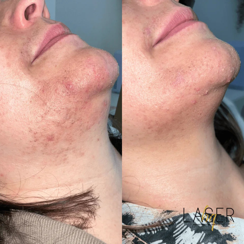 Laser Hair Face Treatments - LaserHQ-MARCA-MEDIA
