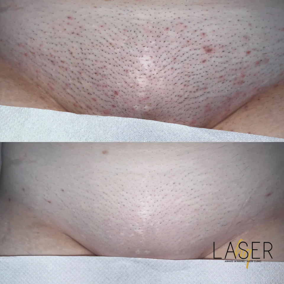 Bikini Prep Packages - LaserHQ-MARCA-MEDIA