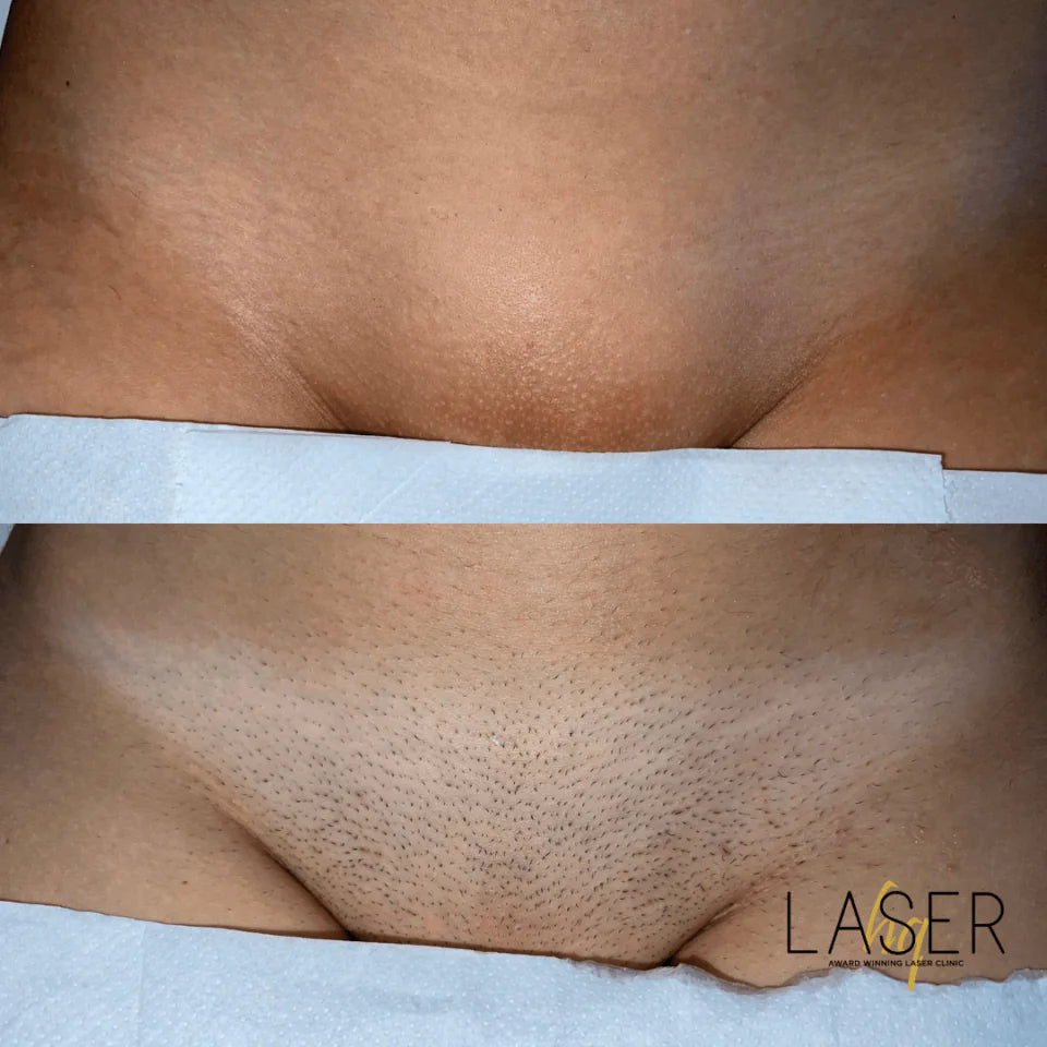 Bikini Prep Packages - LaserHQ-MARCA-MEDIA