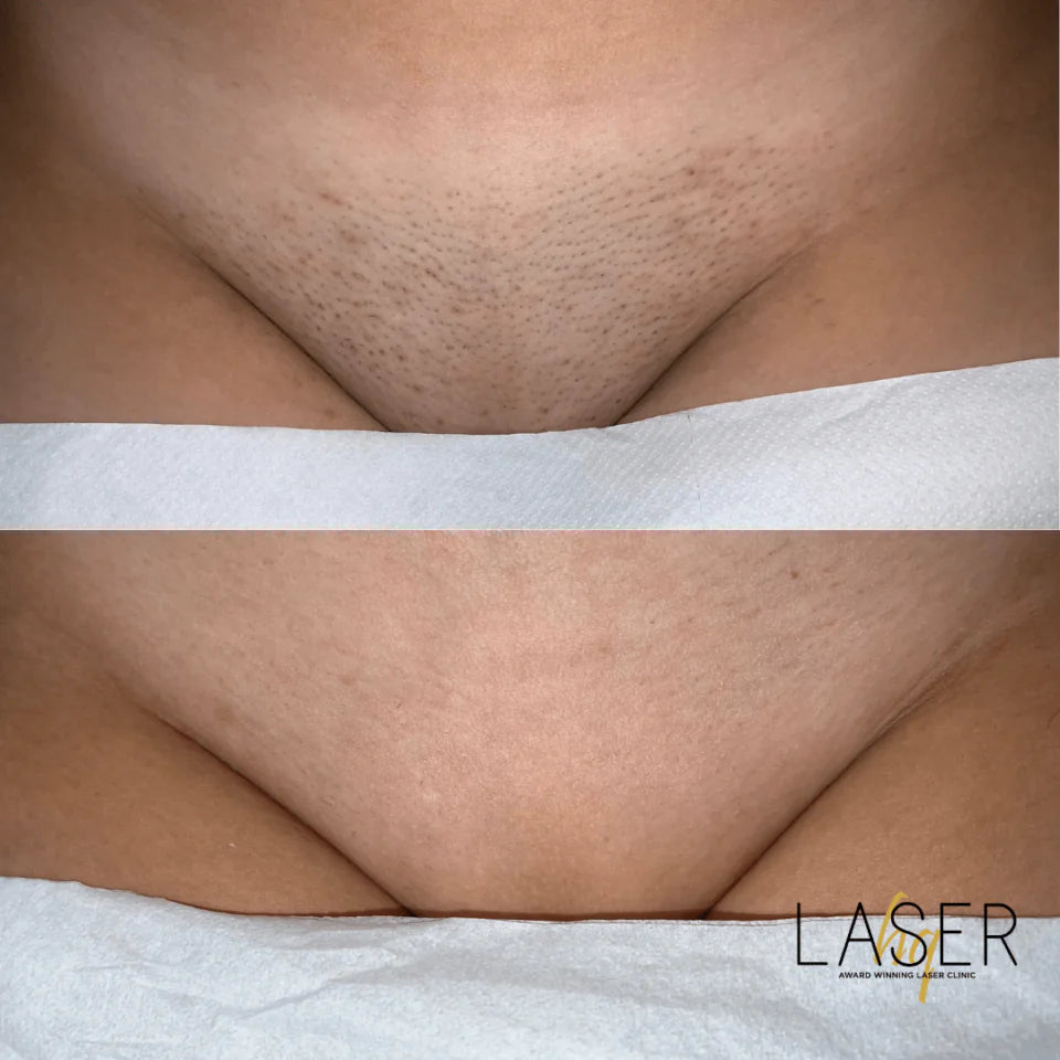 Bikini Prep Packages - LaserHQ-MARCA-MEDIA