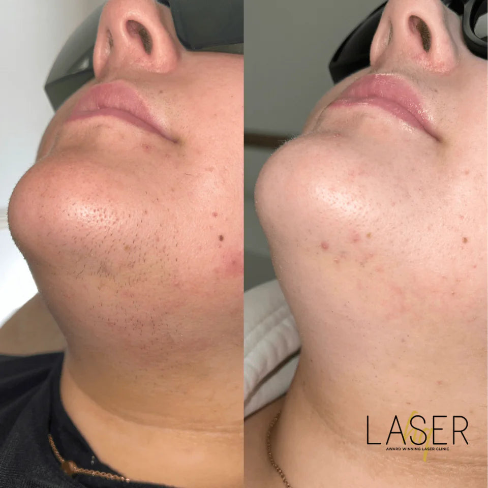 Laser Hair Face Treatments - LaserHQ-MARCA-MEDIA
