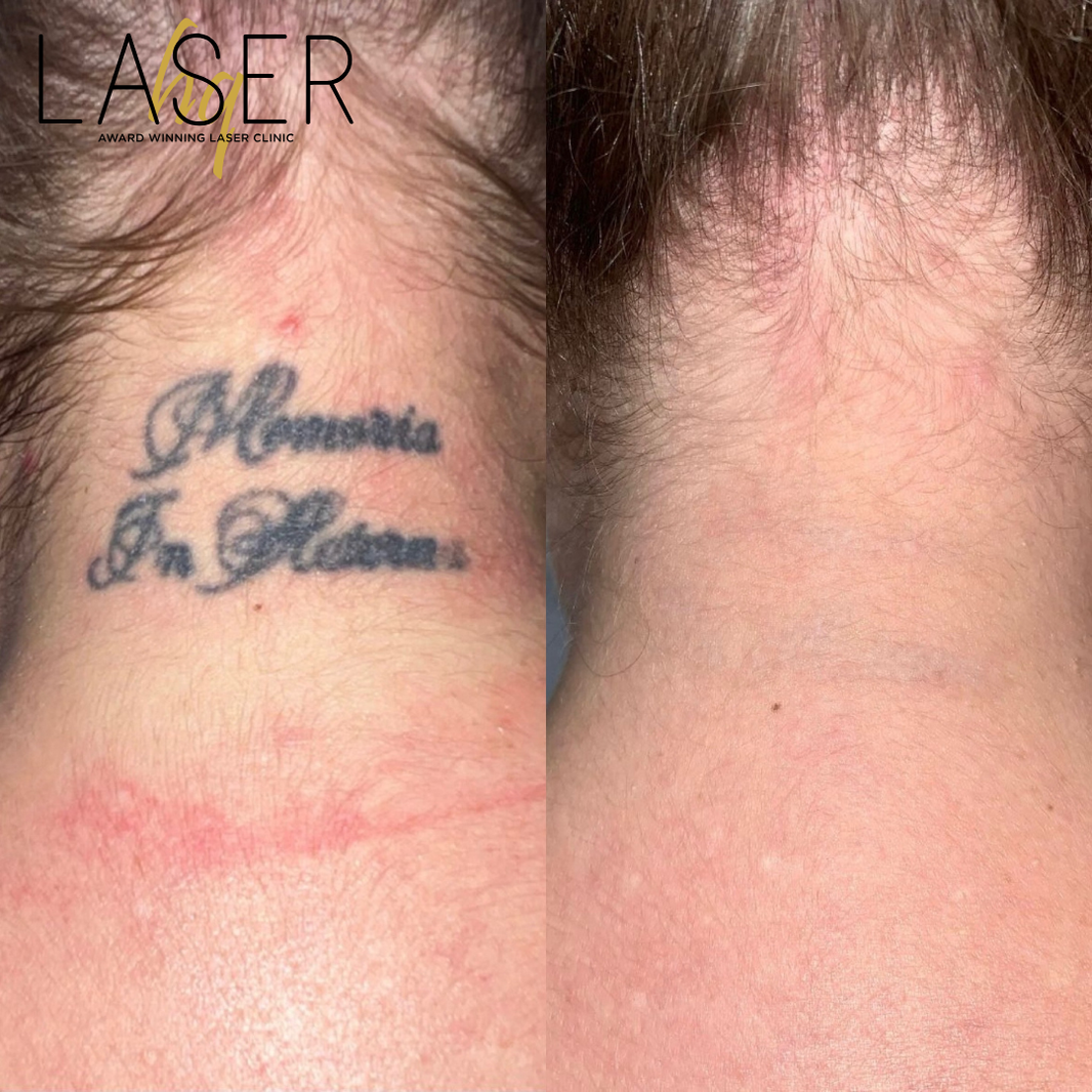 Is tattoo removal actually effective?