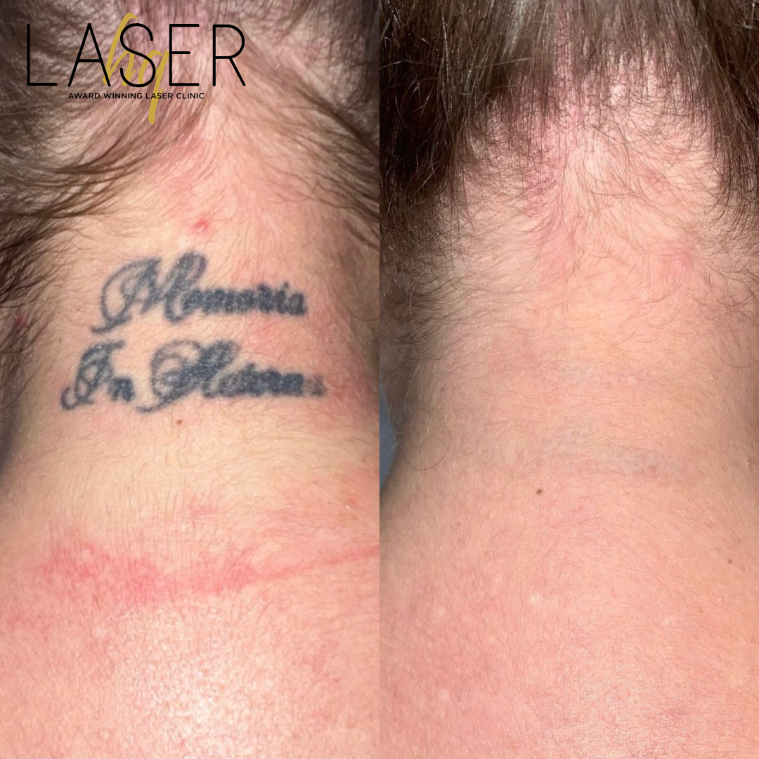 Is tattoo removal actually effective?