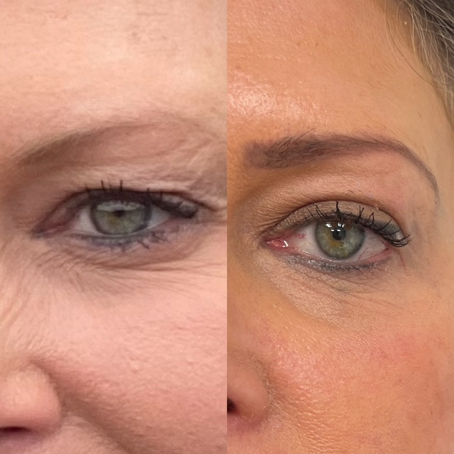Discover the Transformative Power of CO₂ Fractional Laser for Upper Eyelids — Now Launching in Manchester
