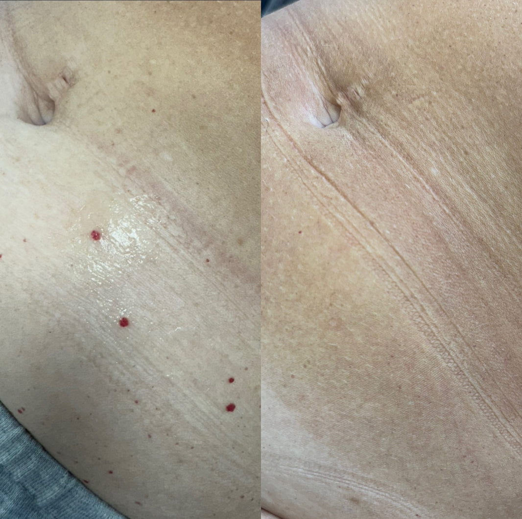 Cherry Angioma/  Blood Blister Removal Is Now Available at All LaserHQ Clinics