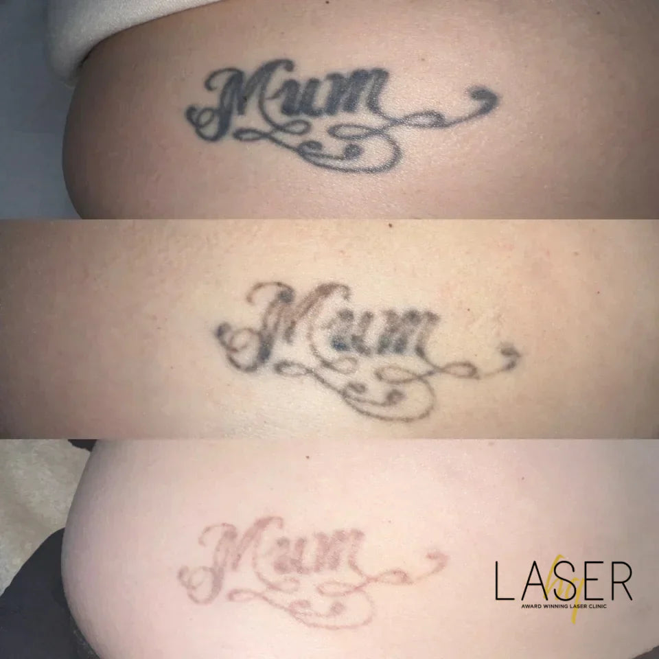 Is tattoo removal actually effective?