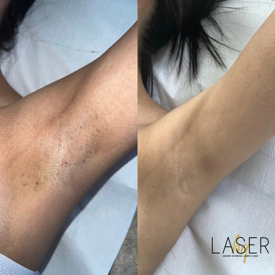 Full Body Package - LaserHQ-MARCA-MEDIA