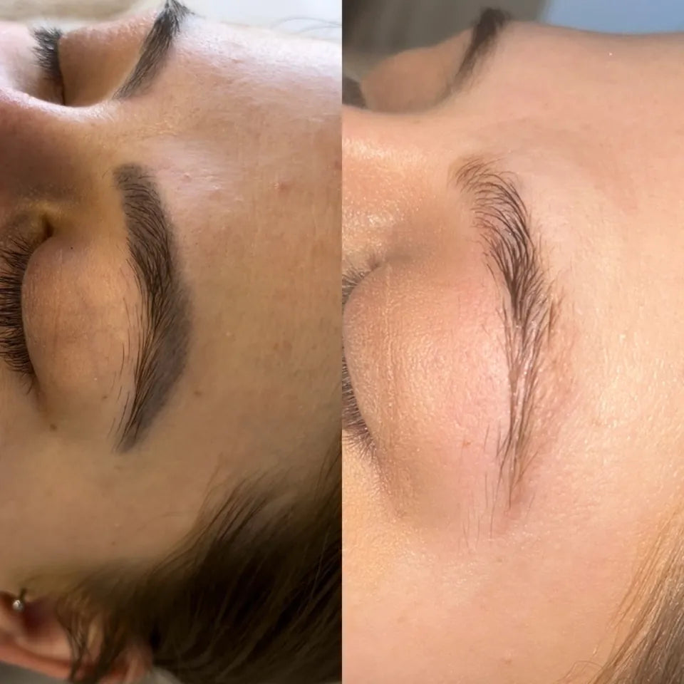 Eyebrow Tattoo Removal - LaserHQ-MARCA-MEDIA