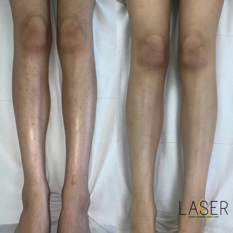 Full Body Package - LaserHQ-MARCA-MEDIA