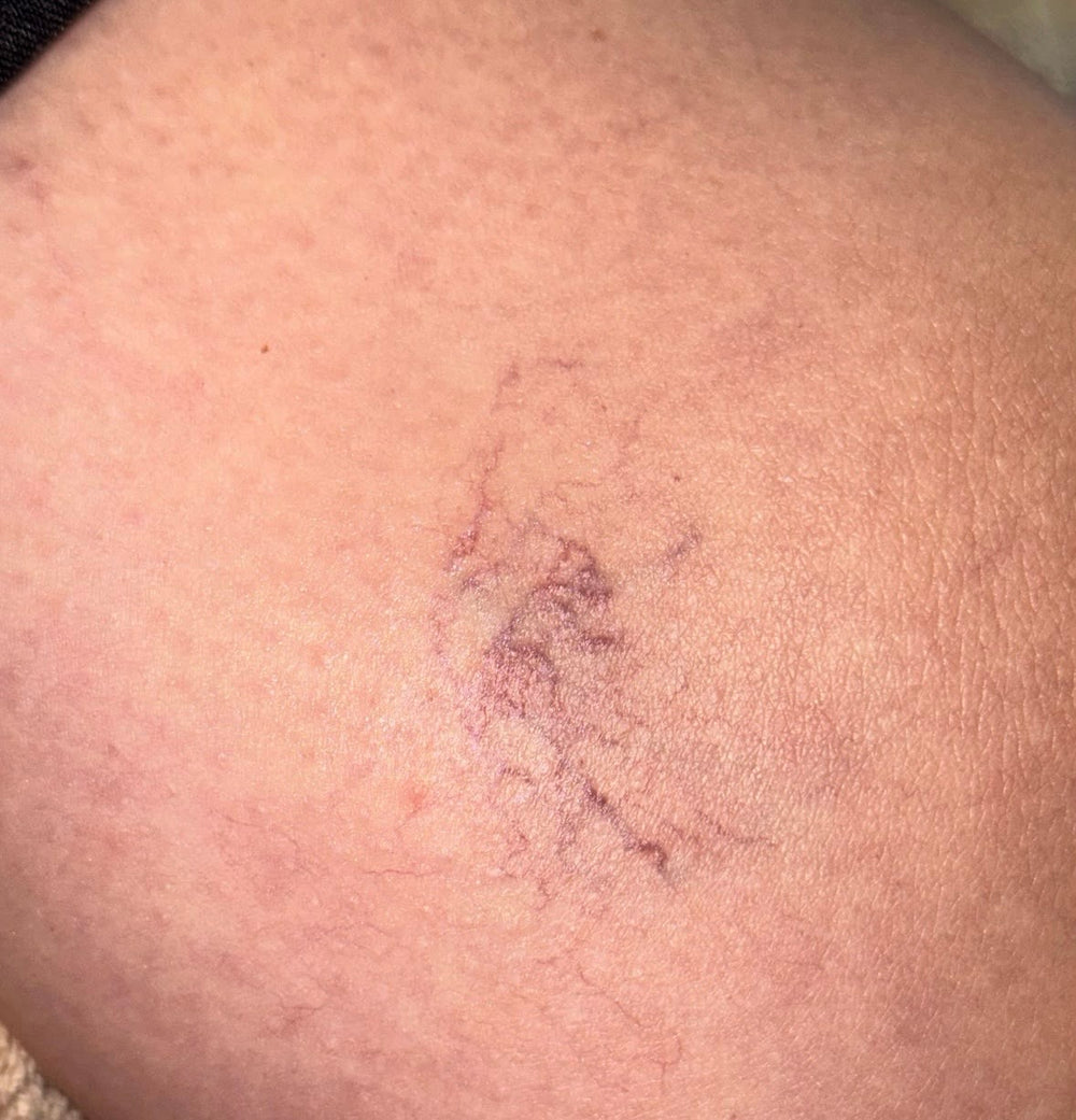 Thread Vein Removal