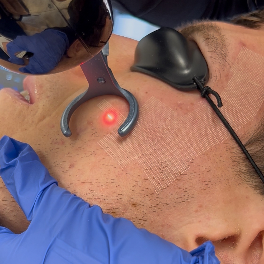 C02 Fractional Laser