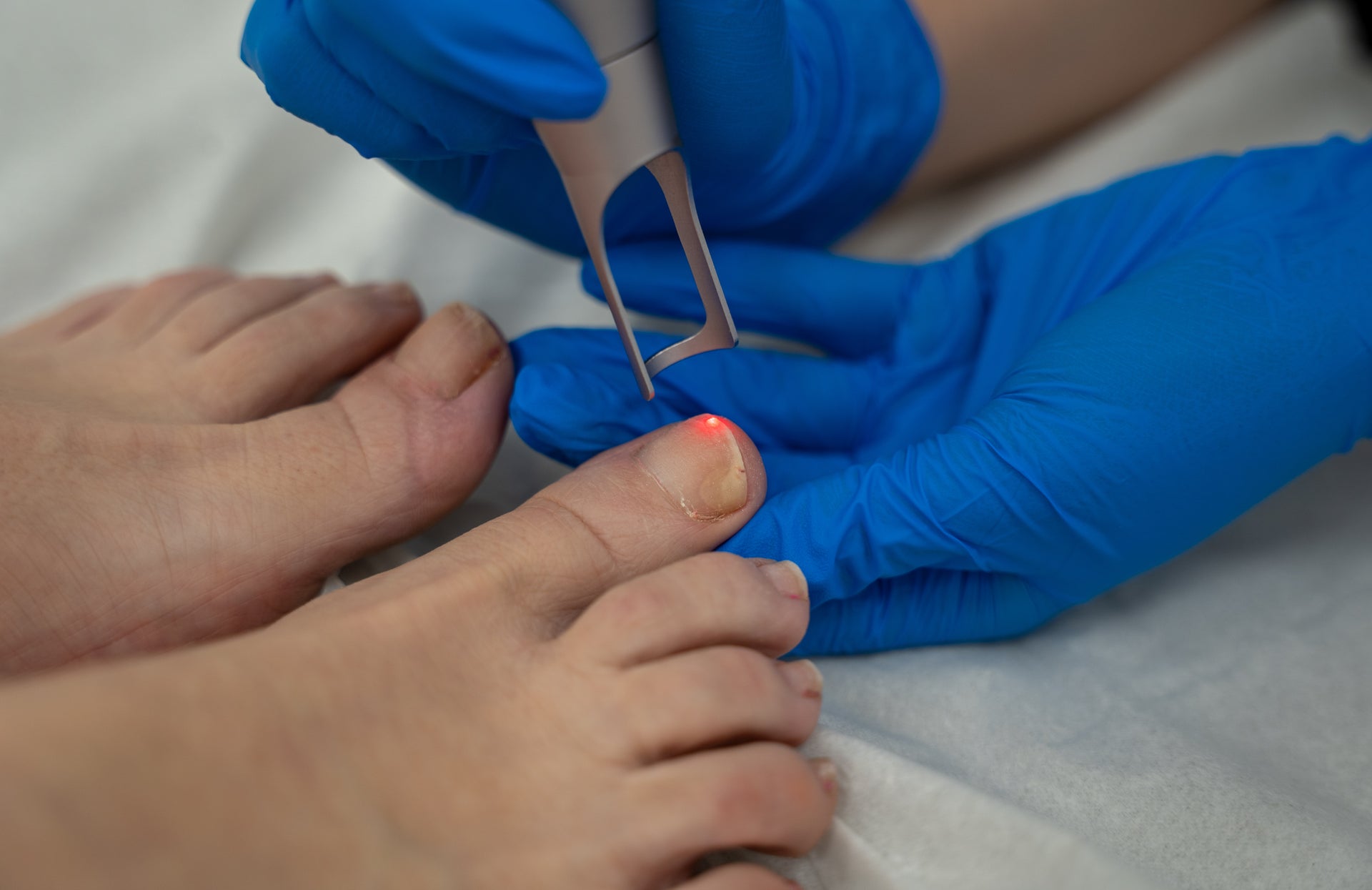 Fungal Nail Laser Treatment Consultation