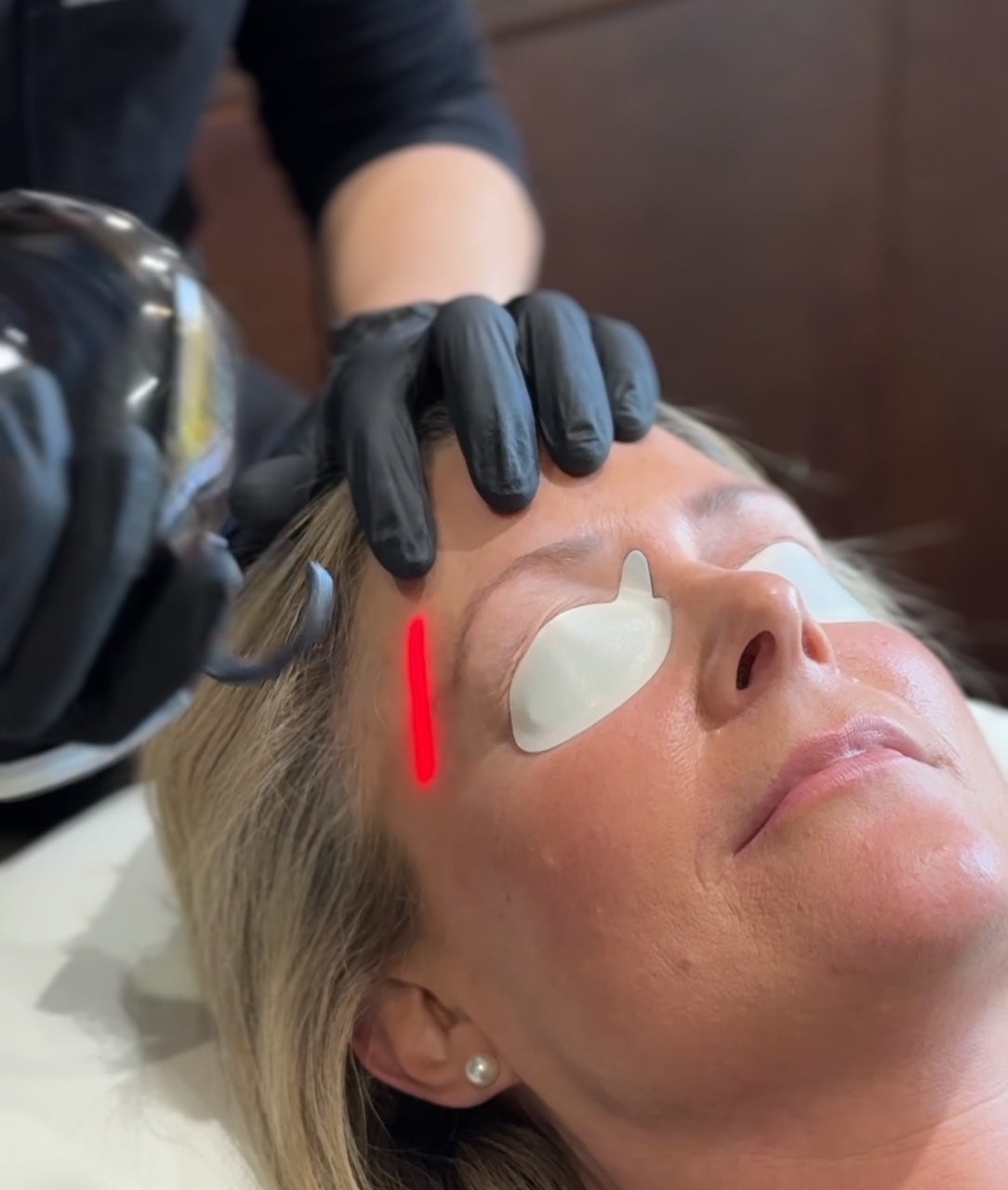 CO₂ Fractional Laser Therapy Consultation