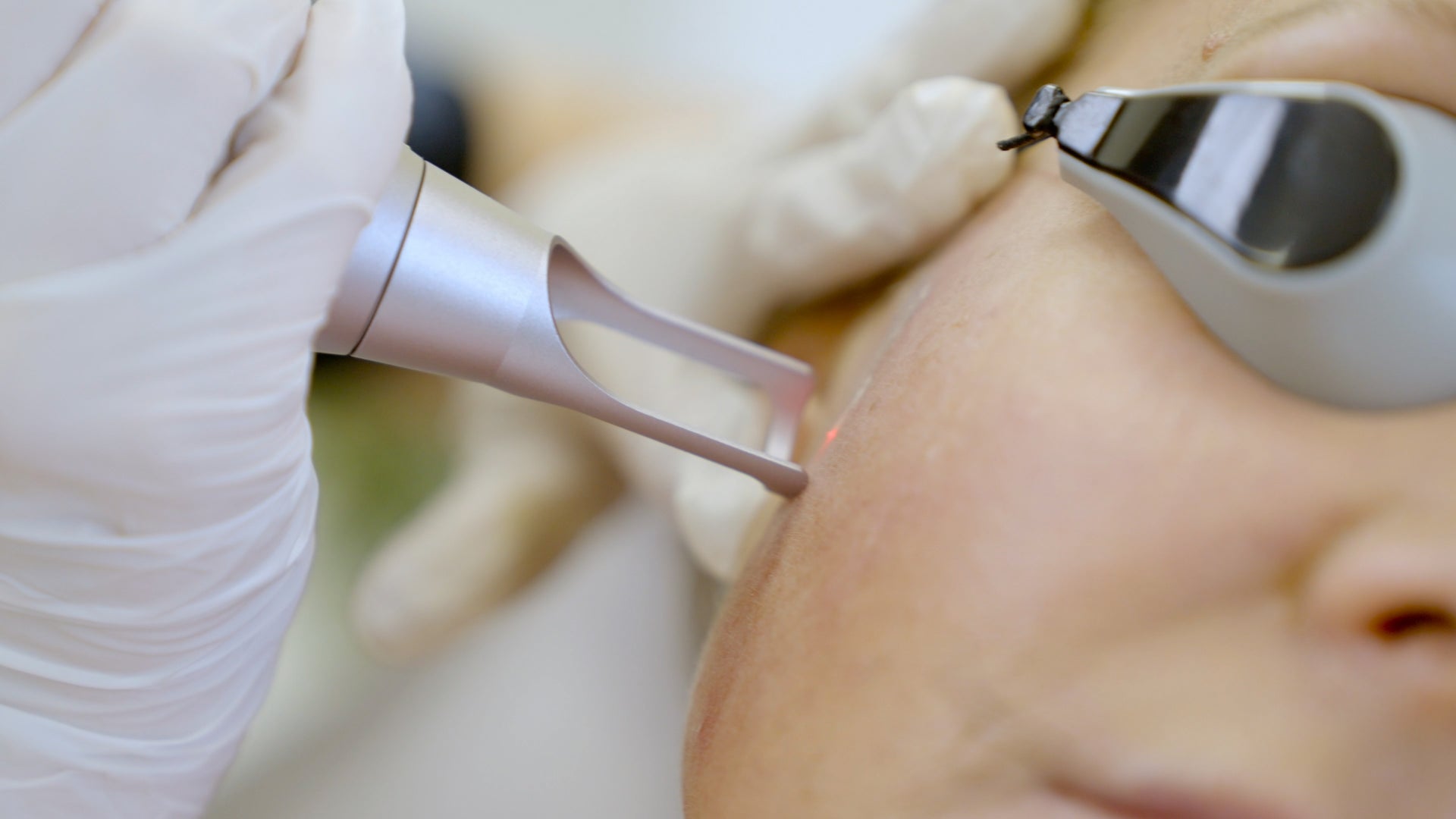 Fractional Laser Consultation - LaserHQ-MARCA-MEDIA