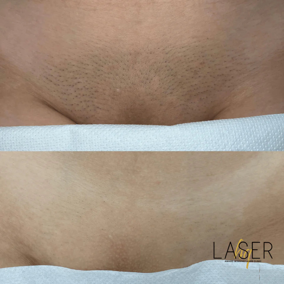 Bikini Prep Packages - LaserHQ-MARCA-MEDIA