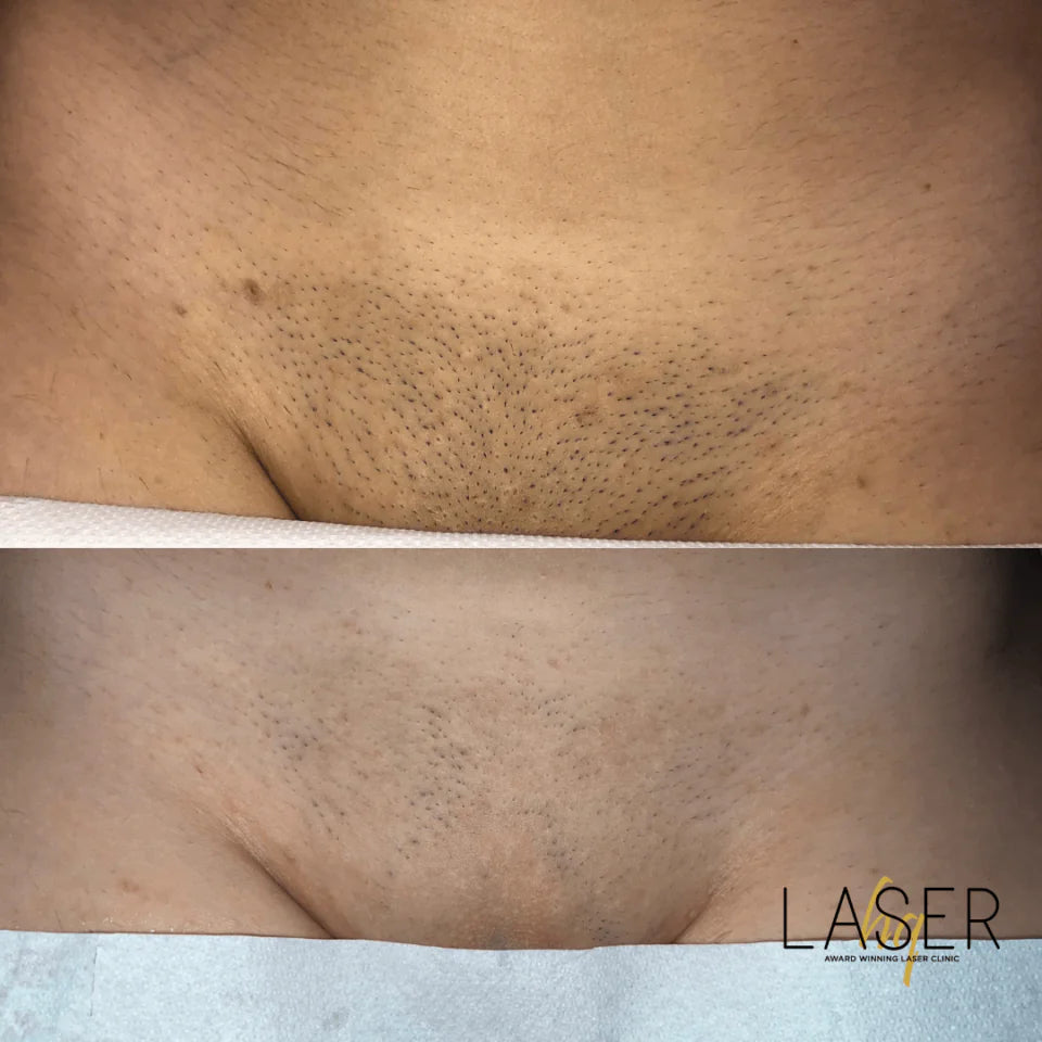 Bikini Prep Packages - LaserHQ-MARCA-MEDIA
