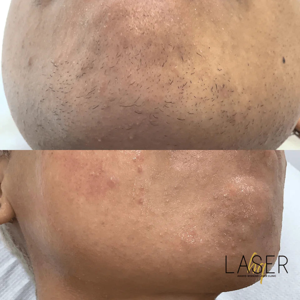 Laser Hair Face Treatments - LaserHQ-MARCA-MEDIA