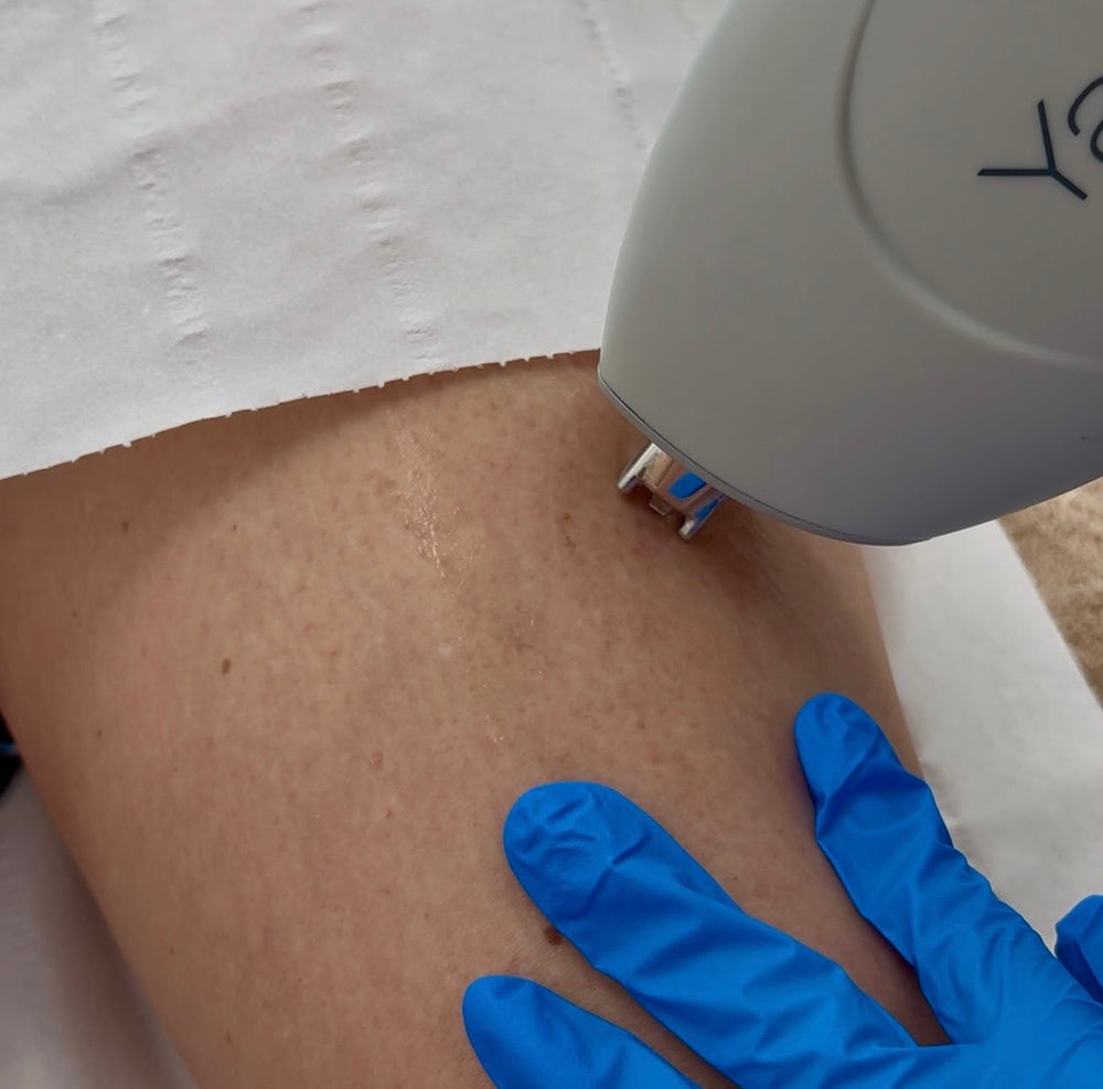 Cherry Angioma Removal