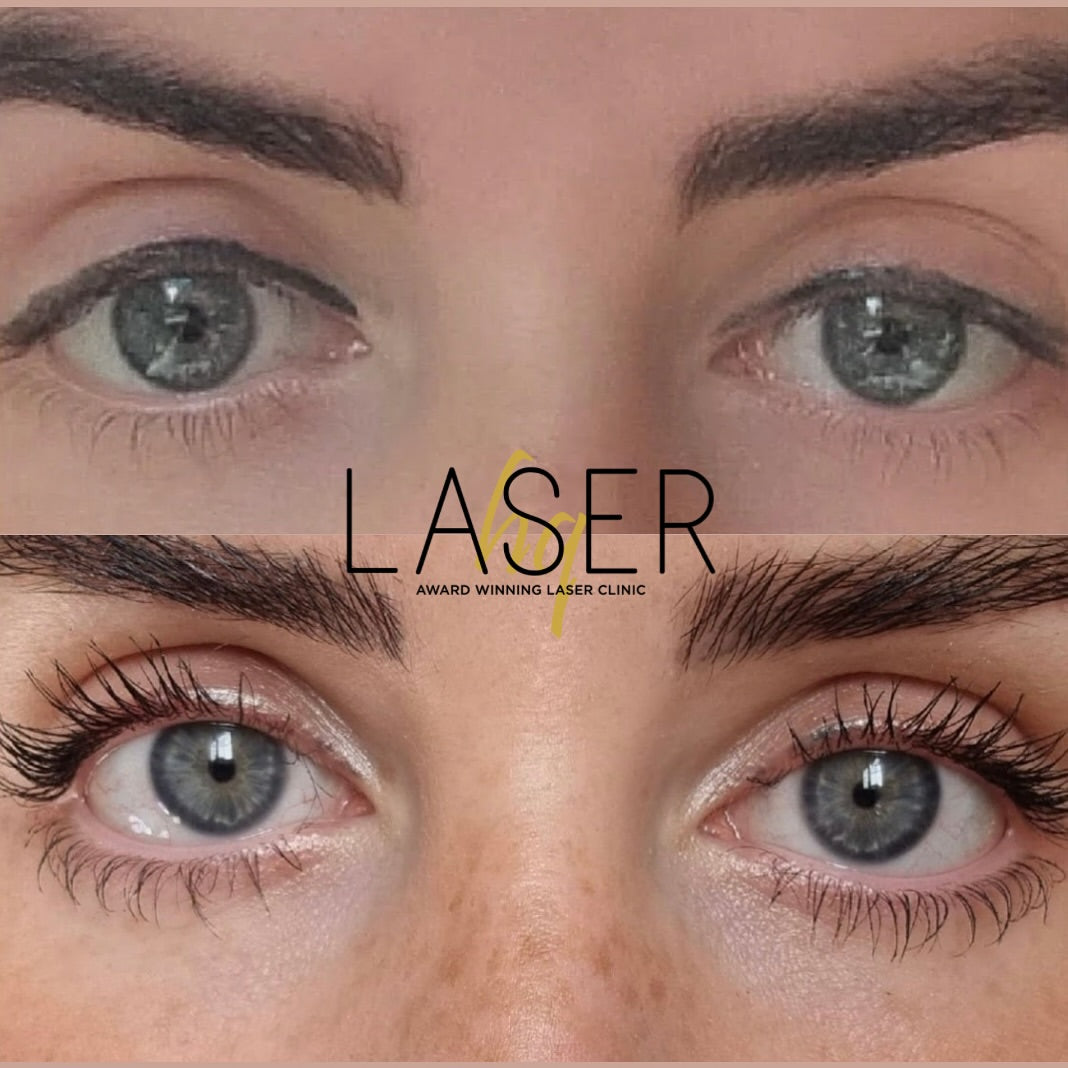 Eyeliner Tattoo Removal